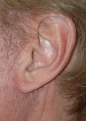 Revision Face Lift - Patient 5 - Lateral Left - After Revision Face Lift - Patient 5 - Lateral Left - After